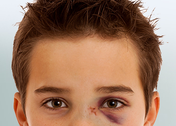 Face of a boy with a bruise under his eyes