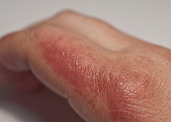 A hand with skin redness