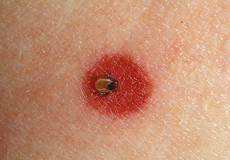 a tick biting in human skin