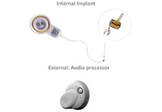 Implant and Audio processor for Middle Ear Implants
