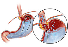 Acid Reflux