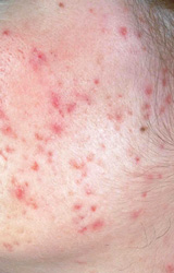 Acne