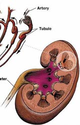 Acute Kidney Failure  