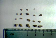 kidney Stones 